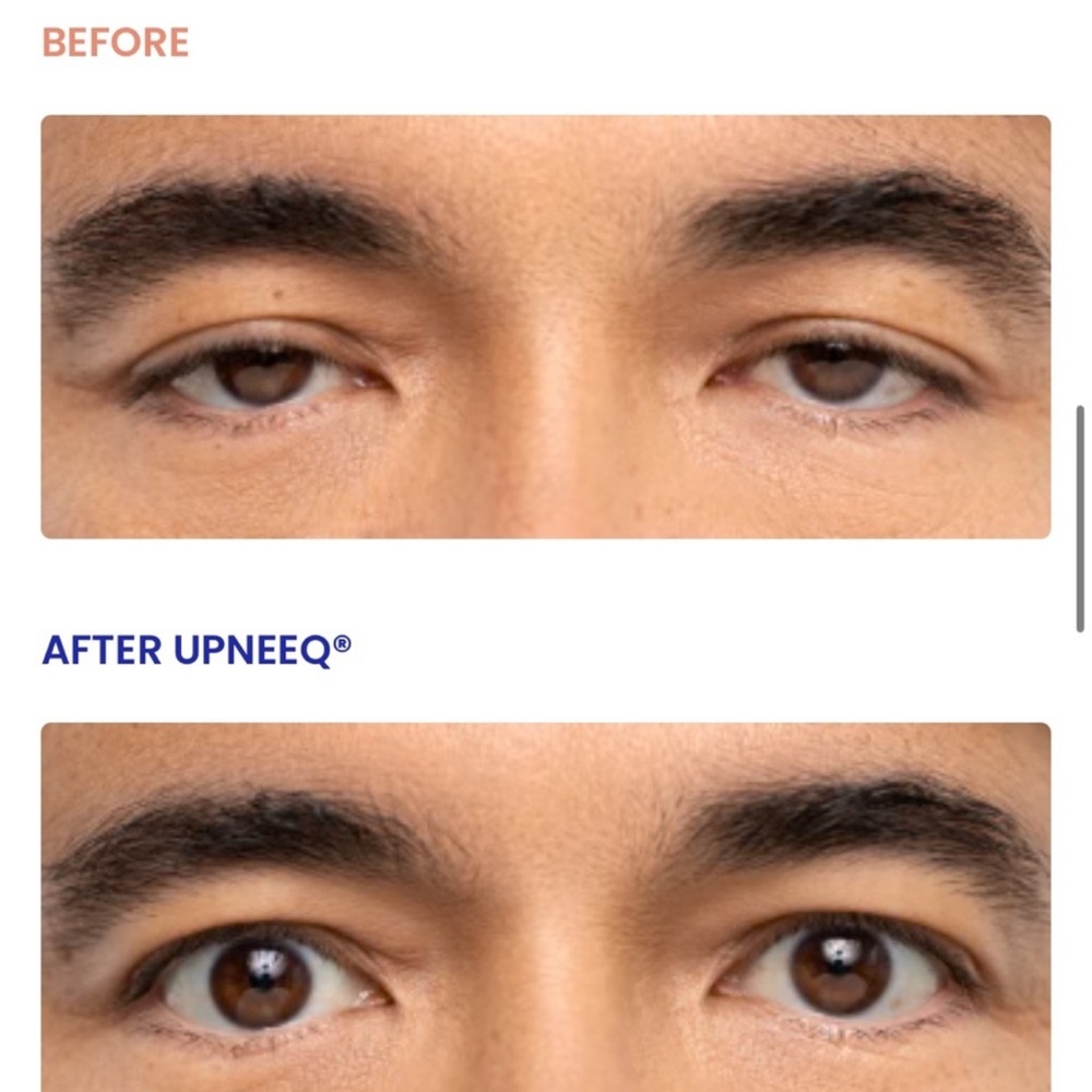 Upneeq Eye Drops -  Pack of 3 - Picture 4 of 8